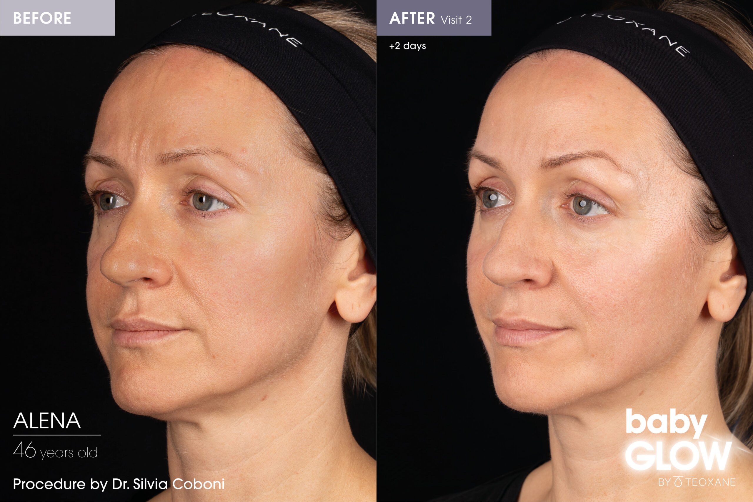 babyGLOW™ by Teoxane The Treatment Everyone Is Talking About this summer