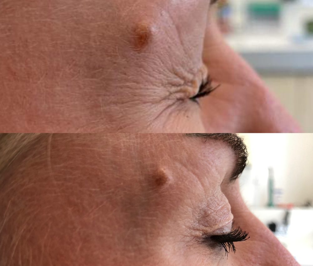 Crows Feet Treated - Before and After